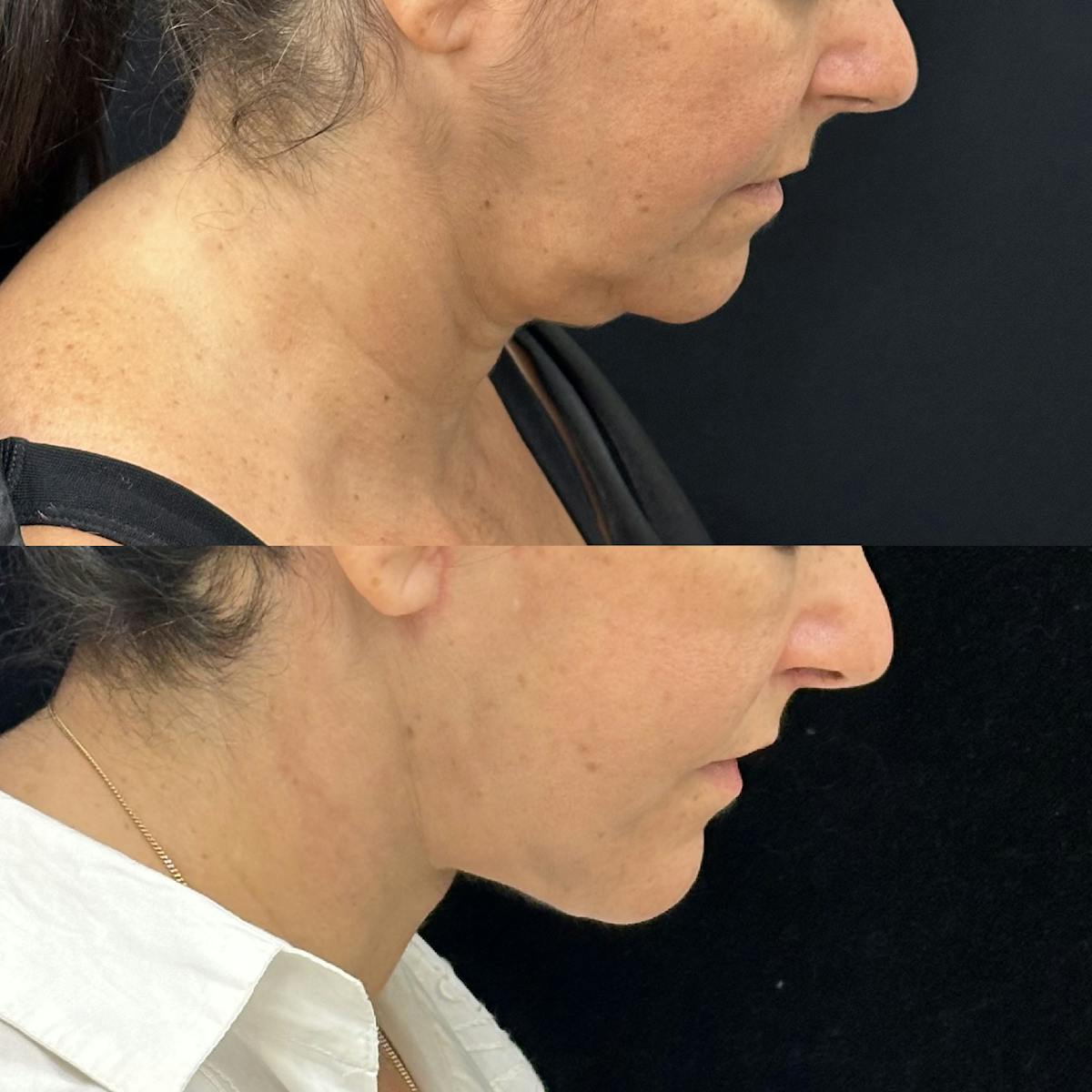 Deep Plane Facelift Before & After Gallery - Patient 193892 - Image 3