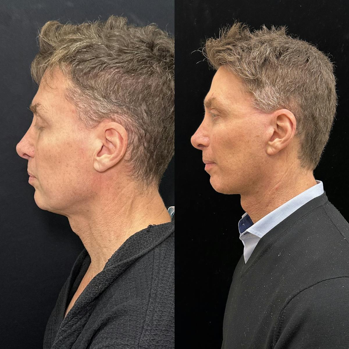 Deep Plane Facelift Before & After Gallery - Patient 413640 - Image 4