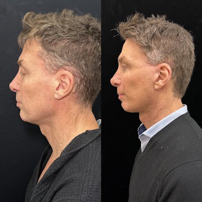 Deep Plane Facelift Before & After Gallery - Patient 413640 - Image 4