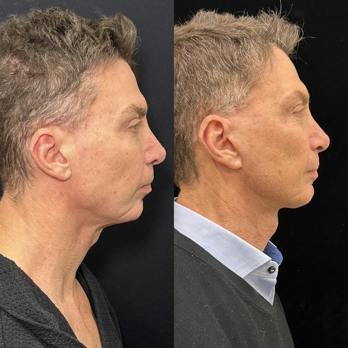 Deep Plane Facelift Before & After Gallery - Patient 413640 - Image 1