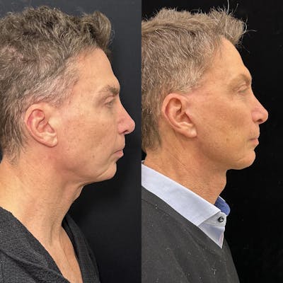 Deep Plane Facelift Before & After Gallery - Patient 413640 - Image 1