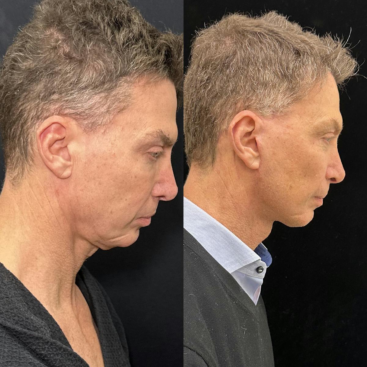Deep Plane Facelift Before & After Gallery - Patient 413640 - Image 3