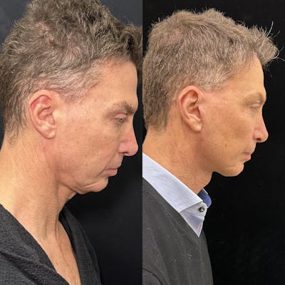 Deep Plane Facelift Before & After Gallery - Patient 413640 - Image 3