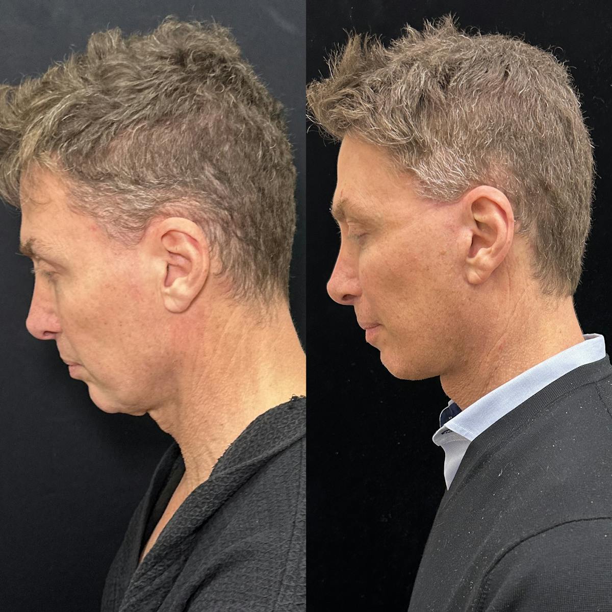 Deep Plane Facelift Before & After Gallery - Patient 413640 - Image 6