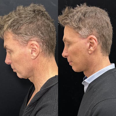 Deep Plane Facelift Before & After Gallery - Patient 413640 - Image 6