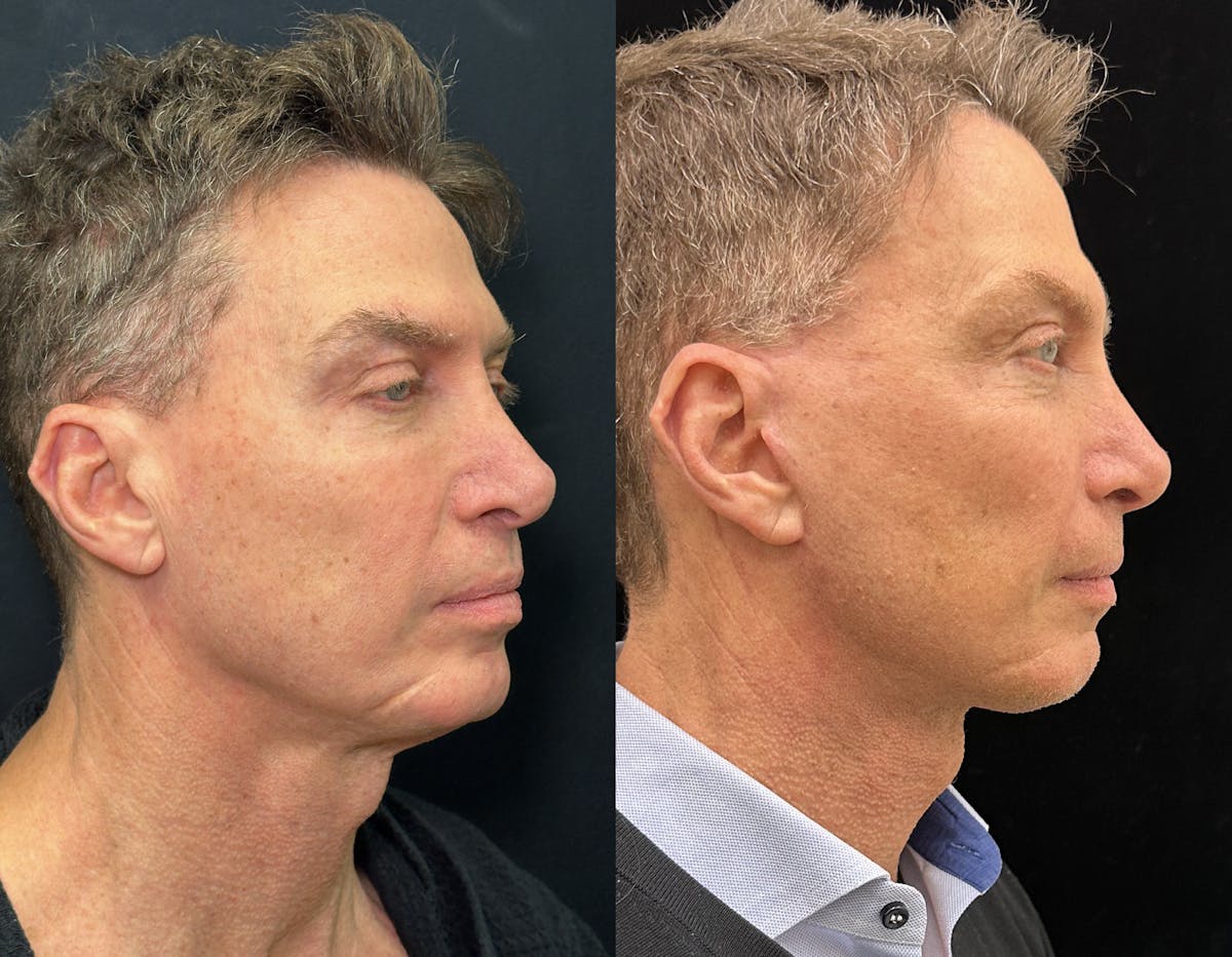 Deep Plane Facelift Before & After Gallery - Patient 413640 - Image 2