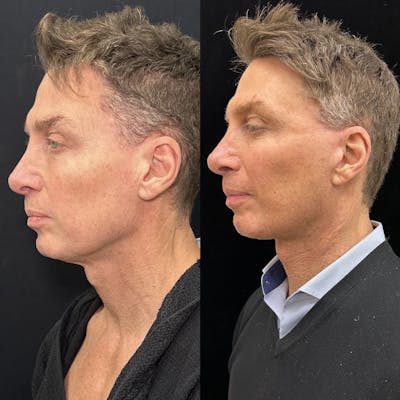 Deep Plane Facelift Before & After Gallery - Patient 413640 - Image 5