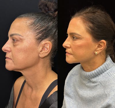 Deep Plane Facelift Before & After Gallery - Patient 340395 - Image 1