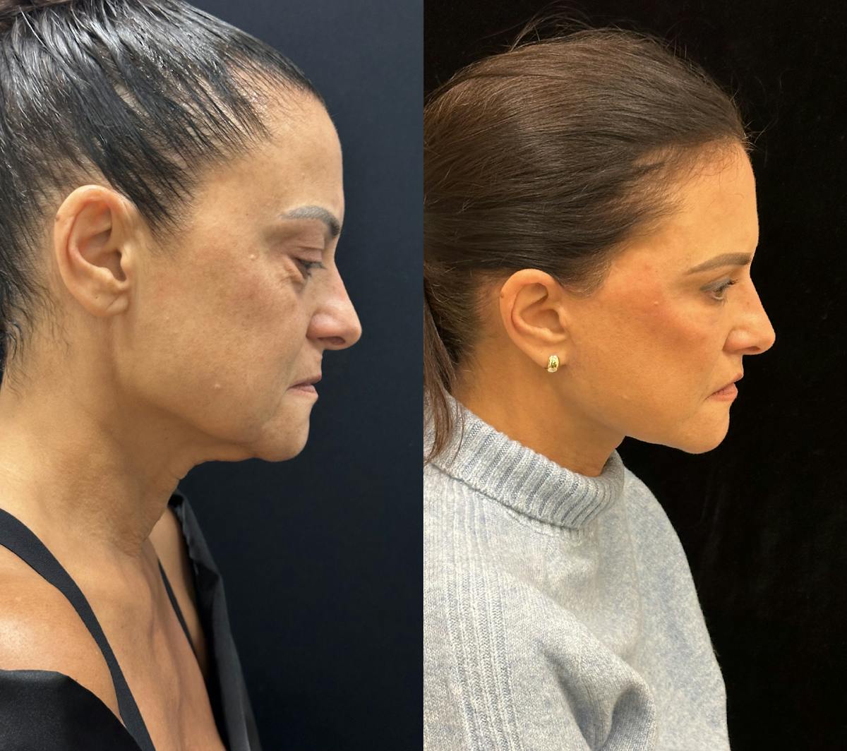 Deep Plane Facelift Before & After Gallery - Patient 340395 - Image 4