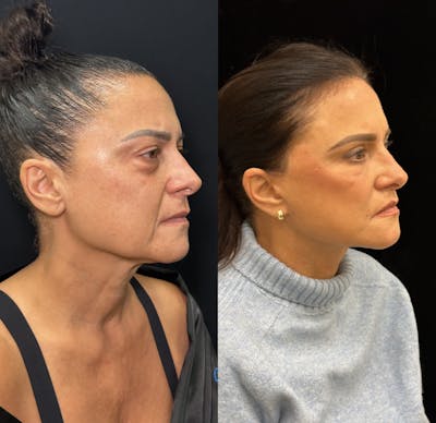 Deep Plane Facelift Before & After Gallery - Patient 340395 - Image 2