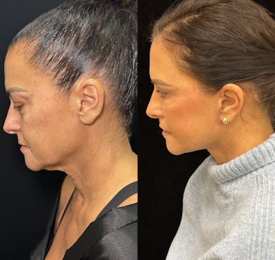 Deep Plane Facelift Before & After Gallery - Patient 340395 - Image 3