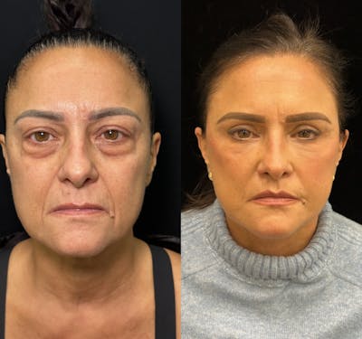 Deep Plane Facelift Before & After Gallery - Patient 340395 - Image 5