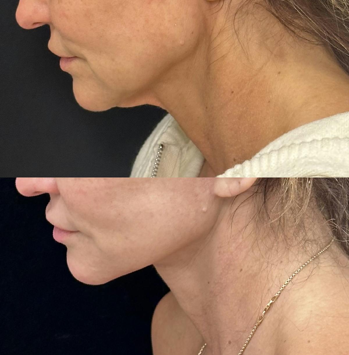 Deep Plane Facelift Before & After Gallery - Patient 230446 - Image 3