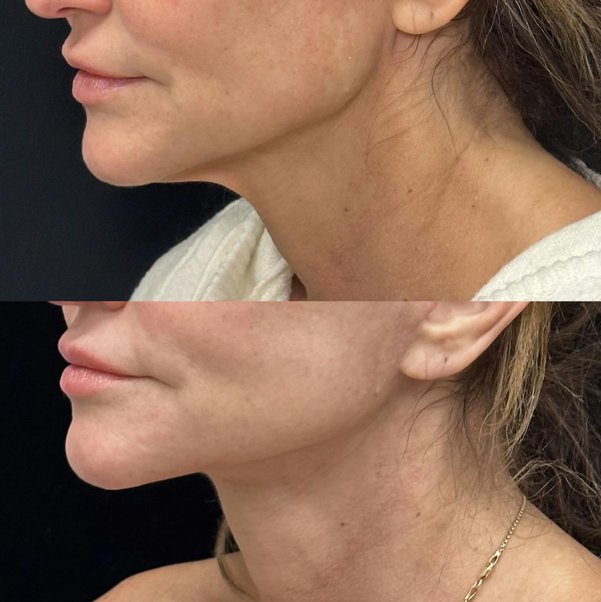 Deep Plane Facelift Before & After Gallery - Patient 230446 - Image 2
