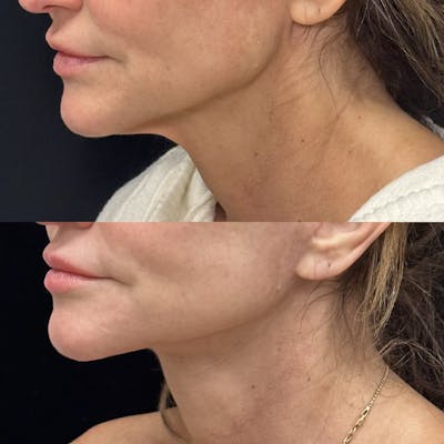 Deep Plane Facelift Before & After Gallery - Patient 230446 - Image 2