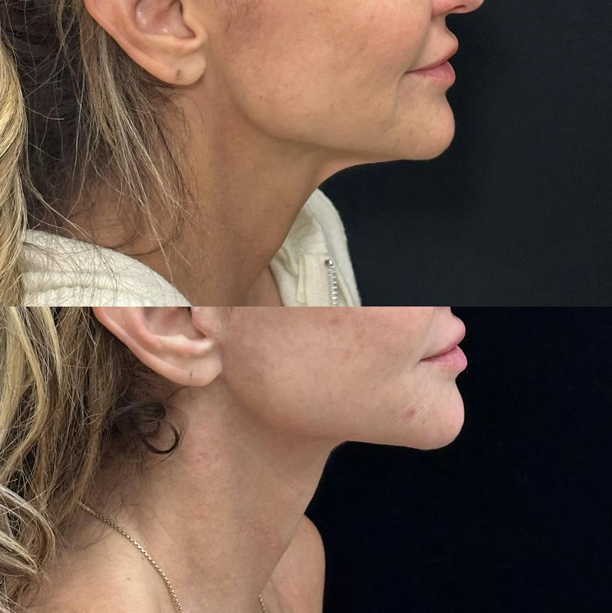 Deep Plane Facelift Before & After Gallery - Patient 230446 - Image 5