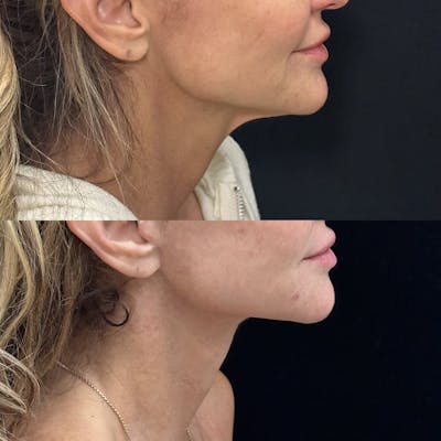 Deep Plane Facelift Before & After Gallery - Patient 230446 - Image 5