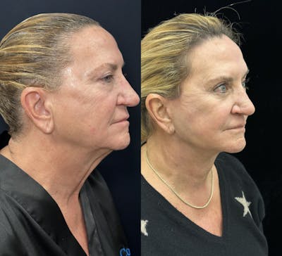 Deep Plane Facelift Before & After Gallery - Patient 264350 - Image 2