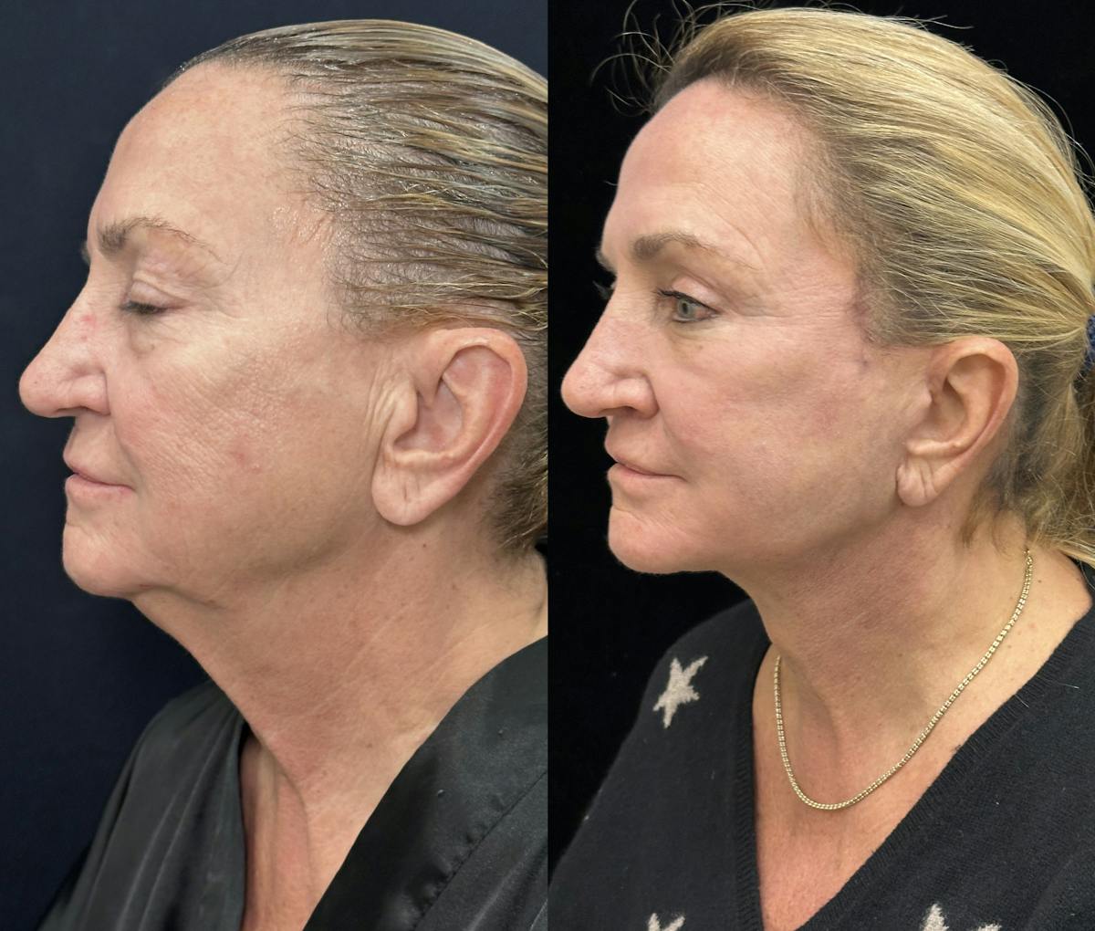 Deep Plane Facelift Before & After Gallery - Patient 264350 - Image 3