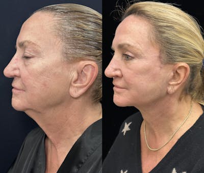 Deep Plane Facelift Before & After Gallery - Patient 264350 - Image 3