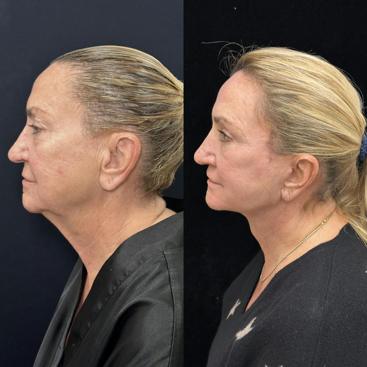 Deep Plane Facelift Before & After Gallery - Patient 264350 - Image 4