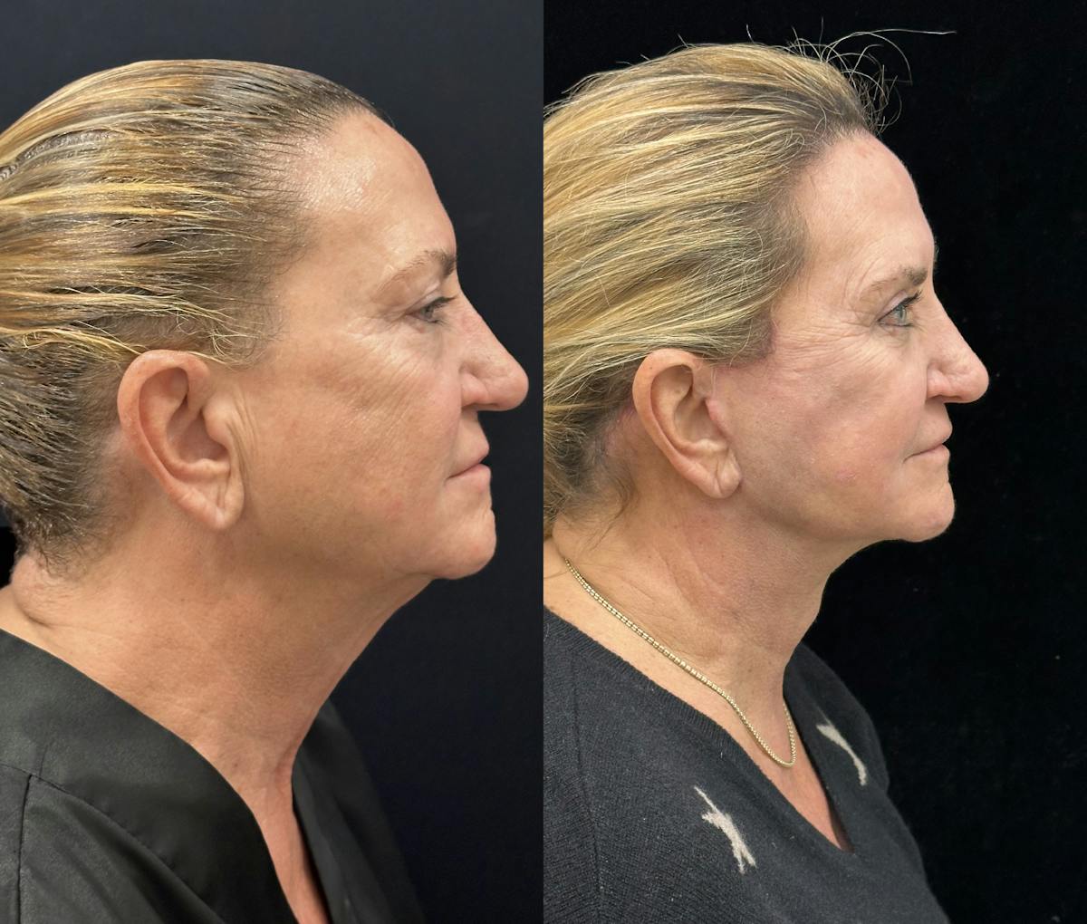 Deep Plane Facelift Before & After Gallery - Patient 264350 - Image 1