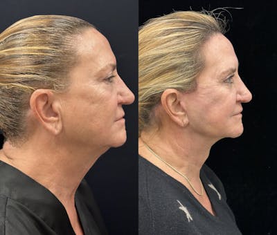 Deep Plane Facelift Before & After Gallery - Patient 264350 - Image 1