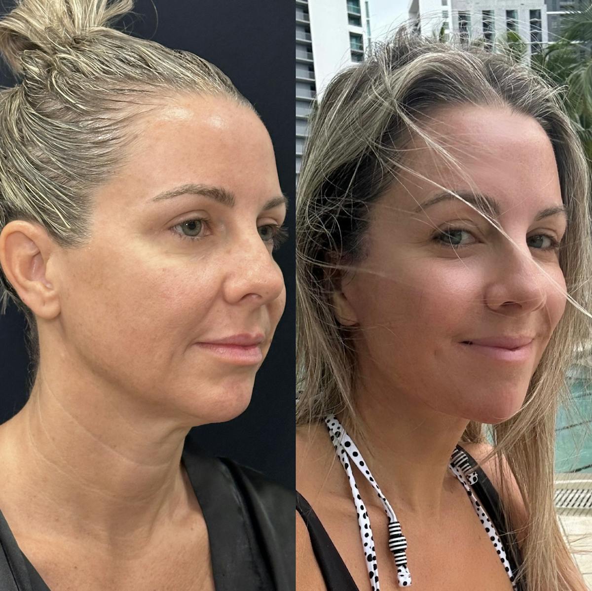 Deep Plane Facelift Before & After Gallery - Patient 251436 - Image 1