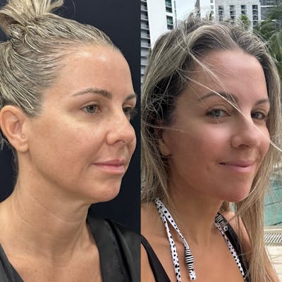 Deep Plane Facelift Before & After Gallery - Patient 251436 - Image 1