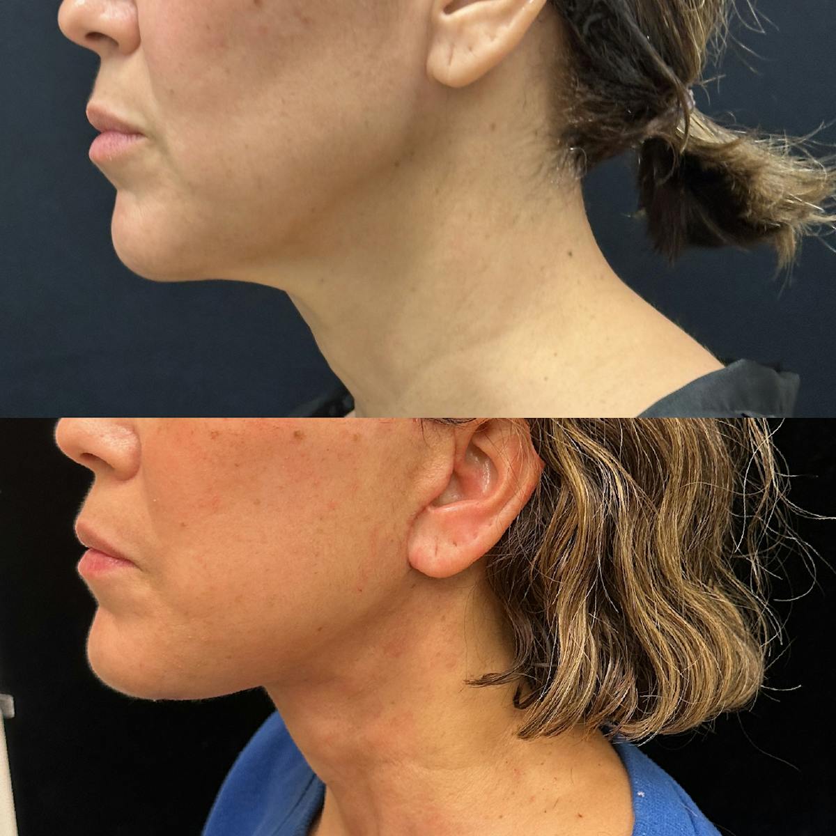 Deep Plane Facelift Before & After Gallery - Patient 278190 - Image 4