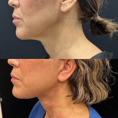 Deep Plane Facelift Before & After Gallery - Patient 278190 - Image 4