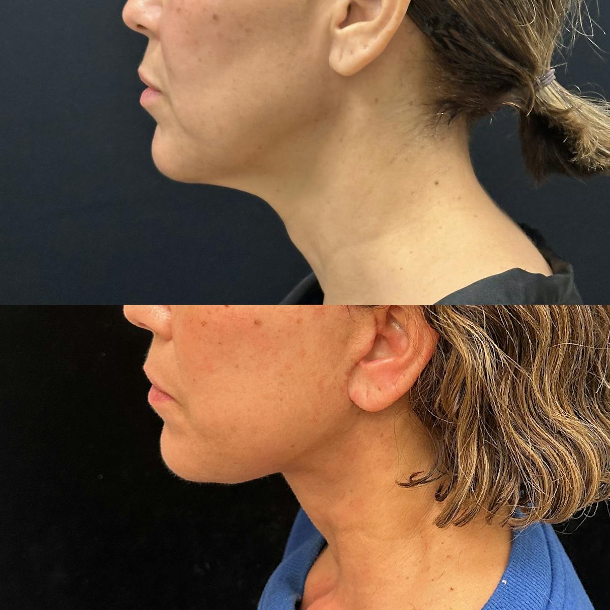 Deep Plane Facelift Before & After Gallery - Patient 278190 - Image 3