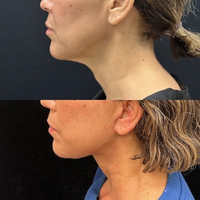 Deep Plane Facelift Before & After Gallery - Patient 278190 - Image 3