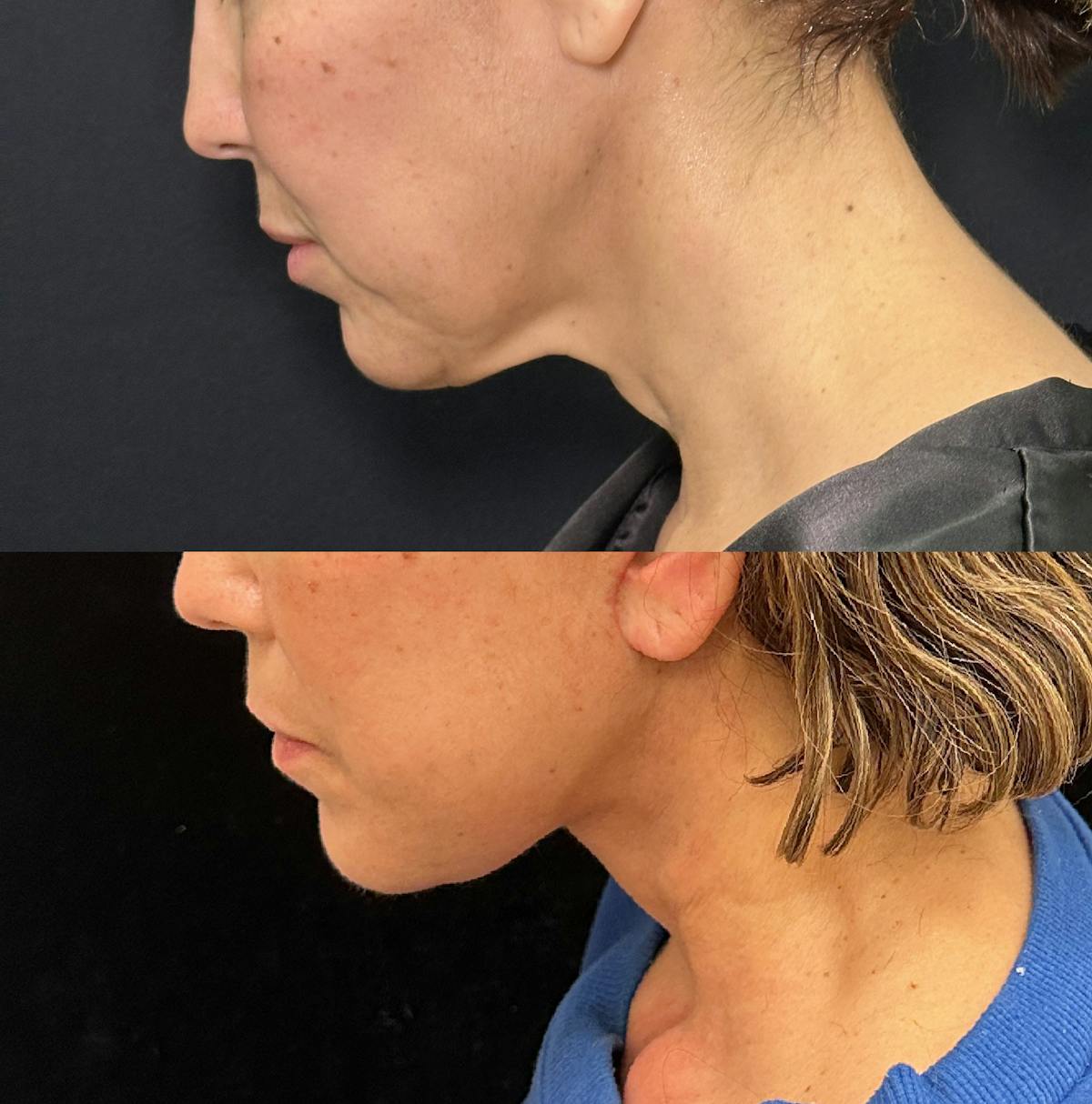 Deep Plane Facelift Before & After Gallery - Patient 278190 - Image 2