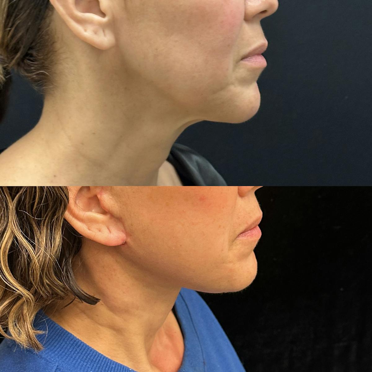 Deep Plane Facelift Before & After Gallery - Patient 278190 - Image 1