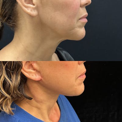 Deep Plane Facelift Before & After Gallery - Patient 278190 - Image 1
