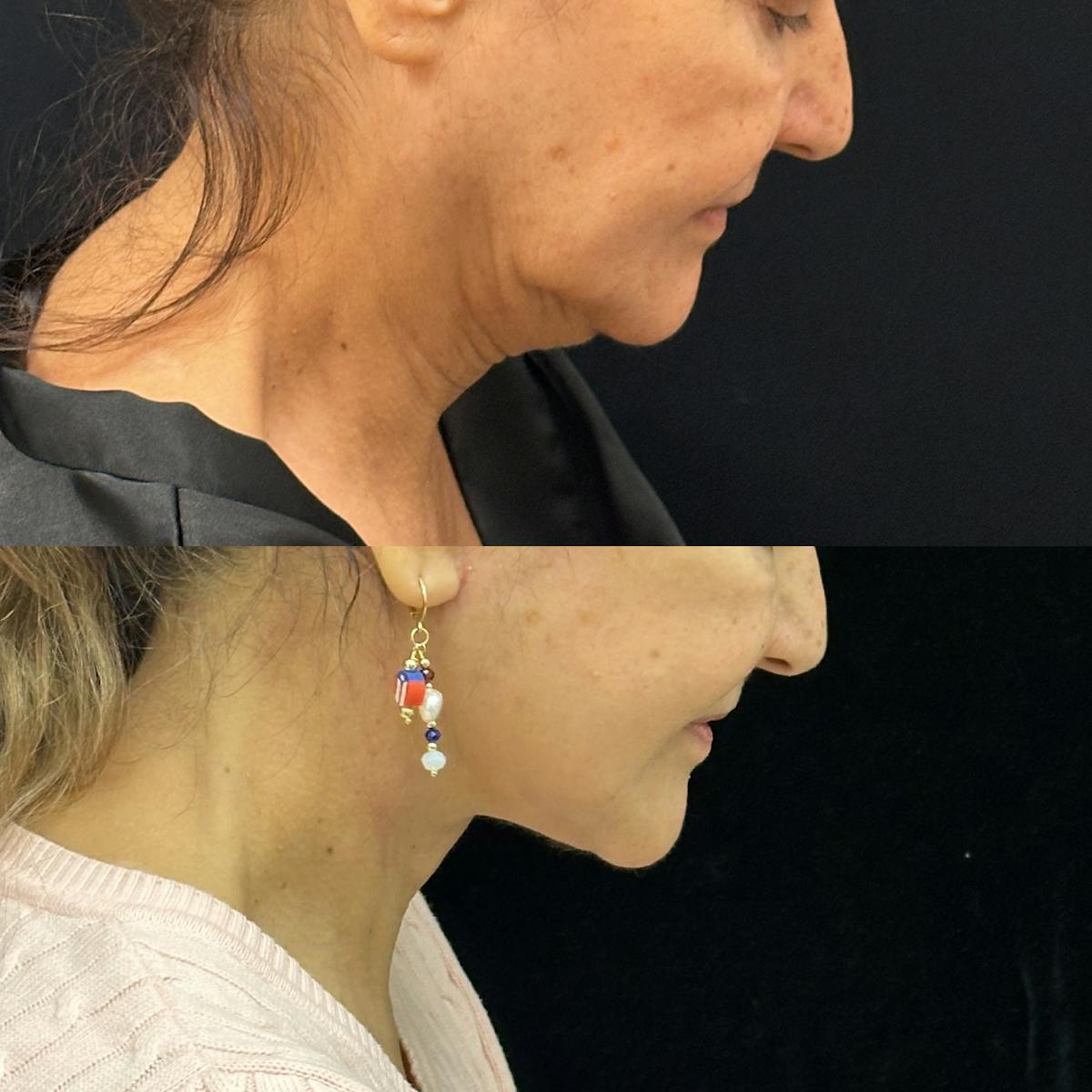 Deep Plane Facelift Before & After Gallery - Patient 143762 - Image 1
