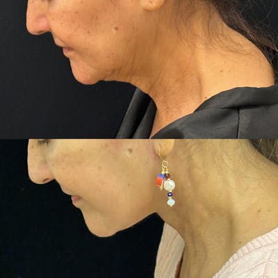 Deep Plane Facelift Before & After Gallery - Patient 143762 - Image 2