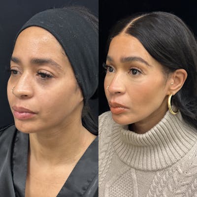 Facial Fat Transfer Before & After Gallery - Patient 364701 - Image 2