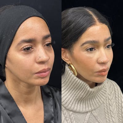 Facial Fat Transfer Before & After Gallery - Patient 364701 - Image 3