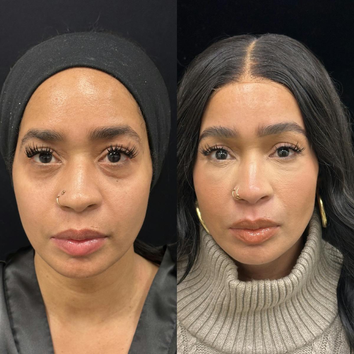 Facial Fat Transfer Before & After Gallery - Patient 364701 - Image 1