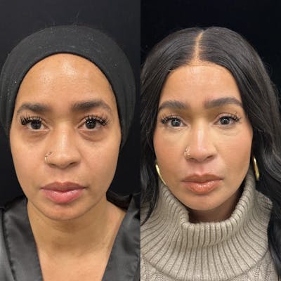 Facial Fat Transfer Before & After Gallery - Patient 364701 - Image 1