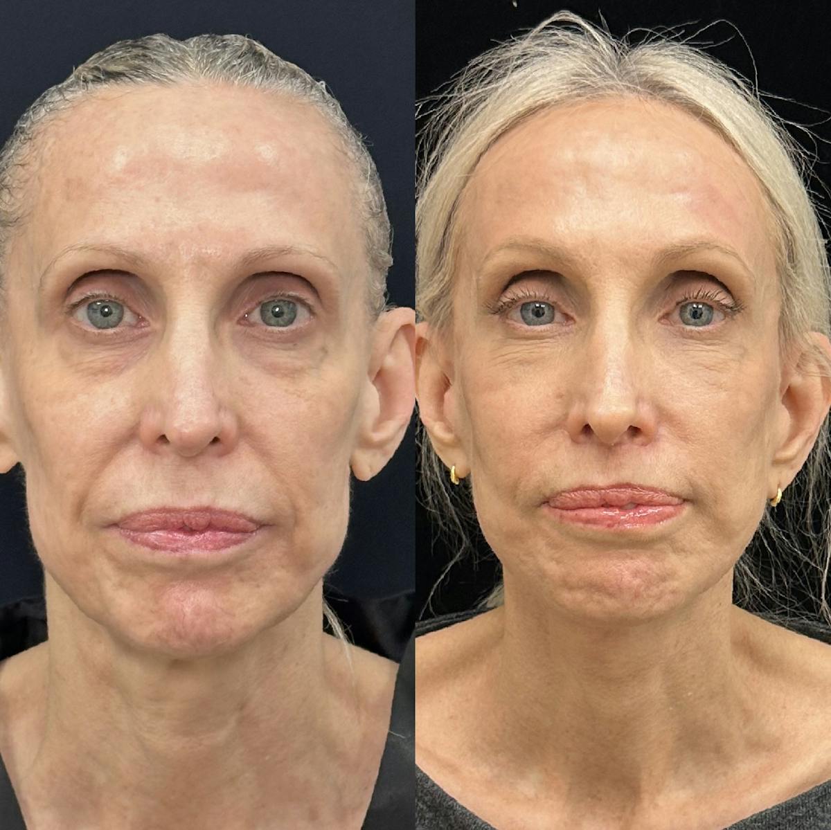 Lip Lift Before & After Gallery - Patient 646816 - Image 1