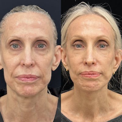 Facial Fat Transfer Before & After Gallery - Patient 334017 - Image 1