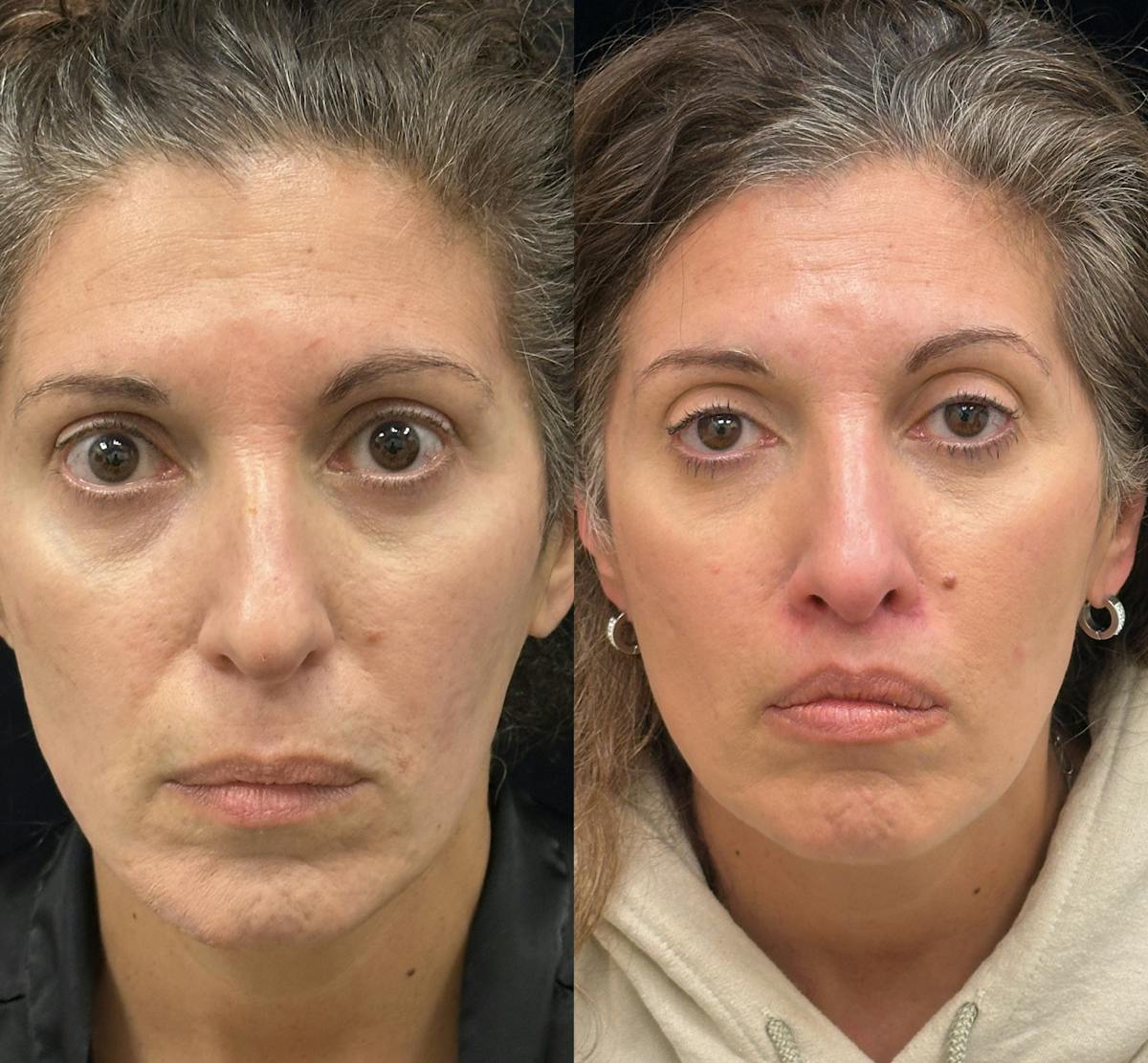 Lip Lift Before & After Gallery - Patient 838090 - Image 1