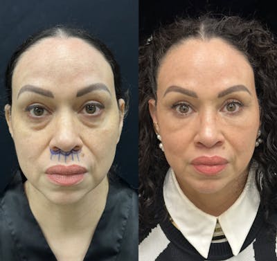 Lip Lift Before & After Gallery - Patient 209043 - Image 1