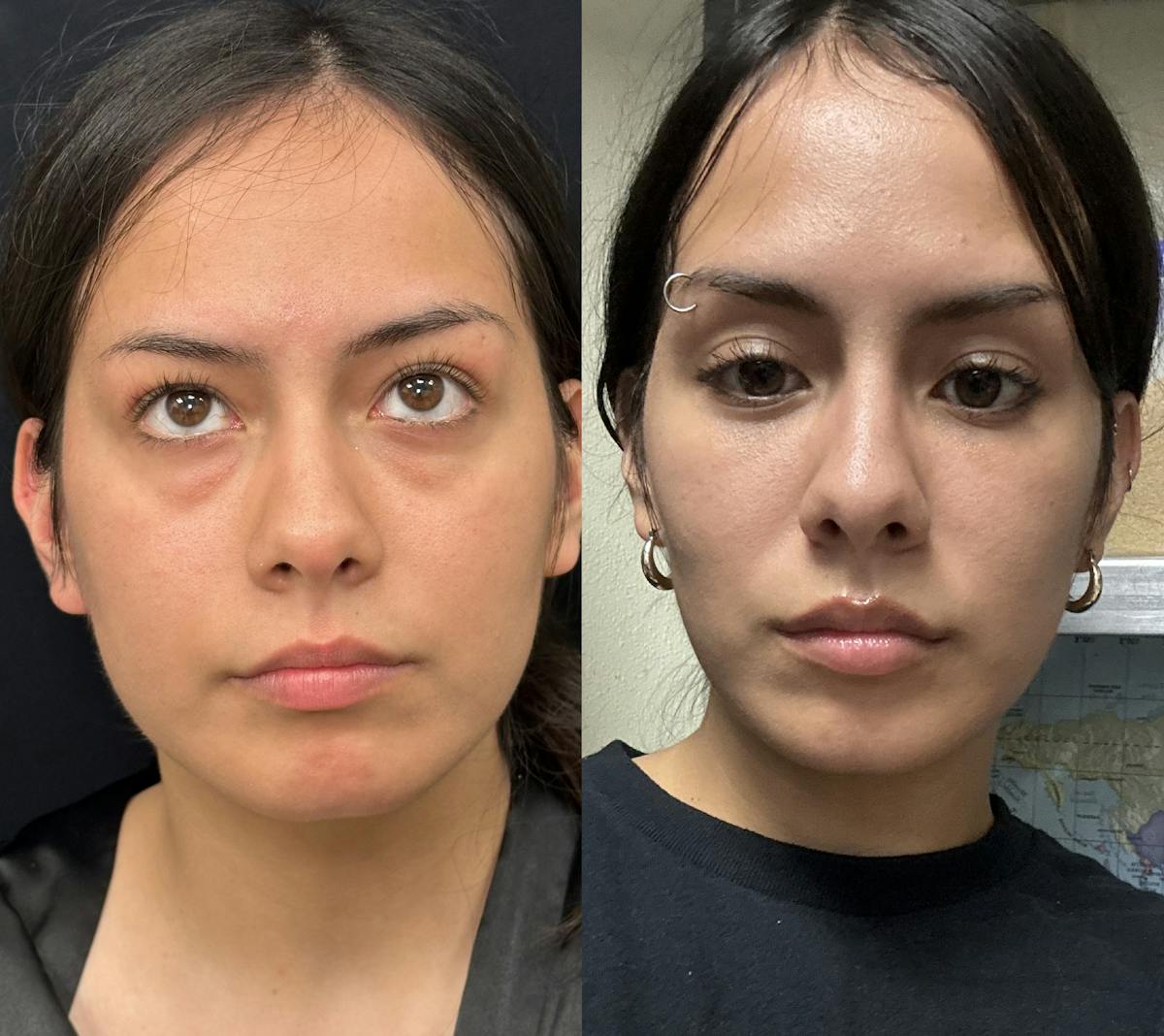 Lower Blepharoplasty Before & After Gallery - Patient 154773 - Image 1