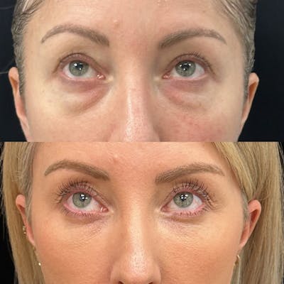 Lower Blepharoplasty Before & After Gallery - Patient 312834 - Image 1