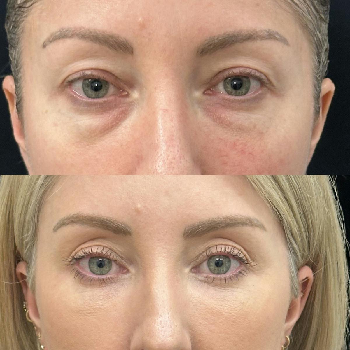 Lower Blepharoplasty Before & After Gallery - Patient 312834 - Image 2