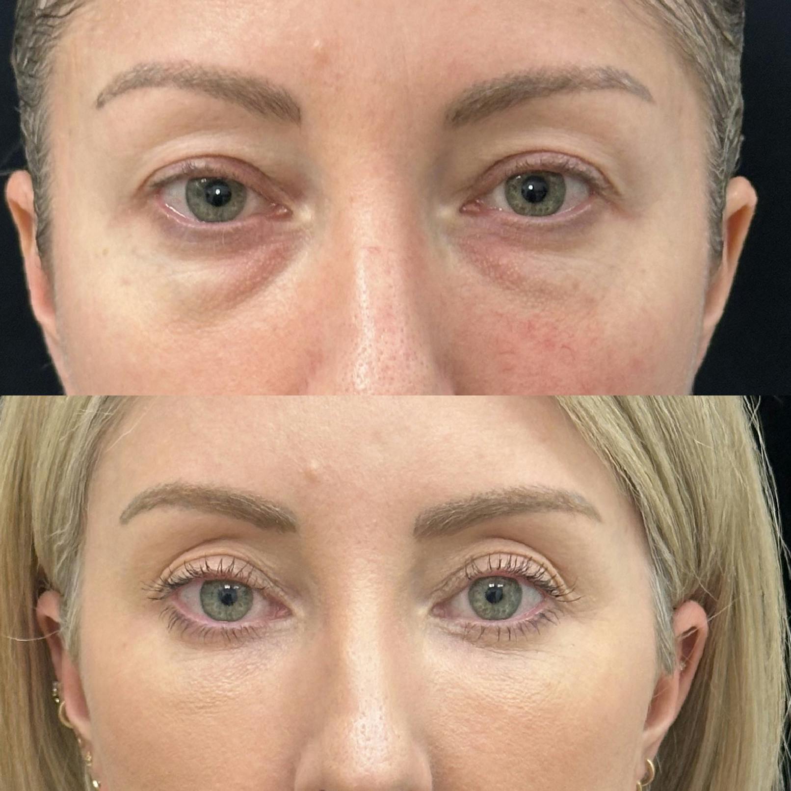 Lower Blepharoplasty Before & After Gallery - Patient 312834 - Image 2